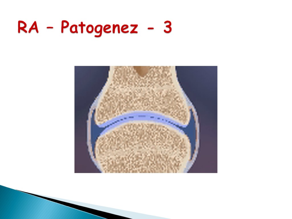 RA – Patogenez - 3